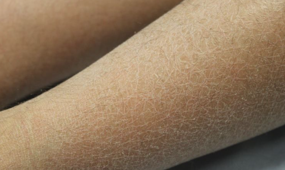 Ichthyosis-vulgaris-2
