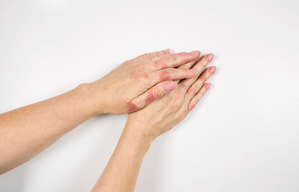 Eczema on the hands. Female hands affected by dermatitis. Close-up